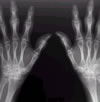 JuvenileRheumatoid Arthritis