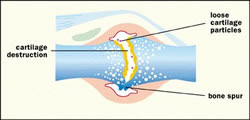 Joint With OSteo Arthritis