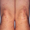 JuvenileRheumatoid Arthritis
