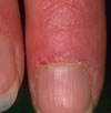 JuvenileRheumatoid Arthritis