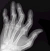 JuvenileRheumatoid Arthritis