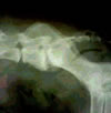 JuvenileRheumatoid Arthritis