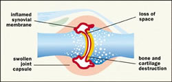 Joint With OSteo Arthritis