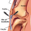 JuvenileRheumatoid Arthritis