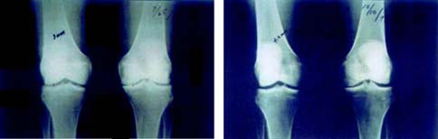 Osteo Arthritis
